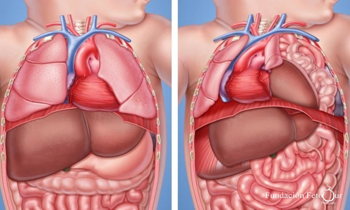 Hernia Diafragmática Congénita