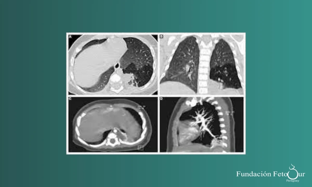 Hidrotórax, Enfermedad Adenomatoidea Quística Pulmonar, Quiste Broncogénico y Secuestro Pulmonar