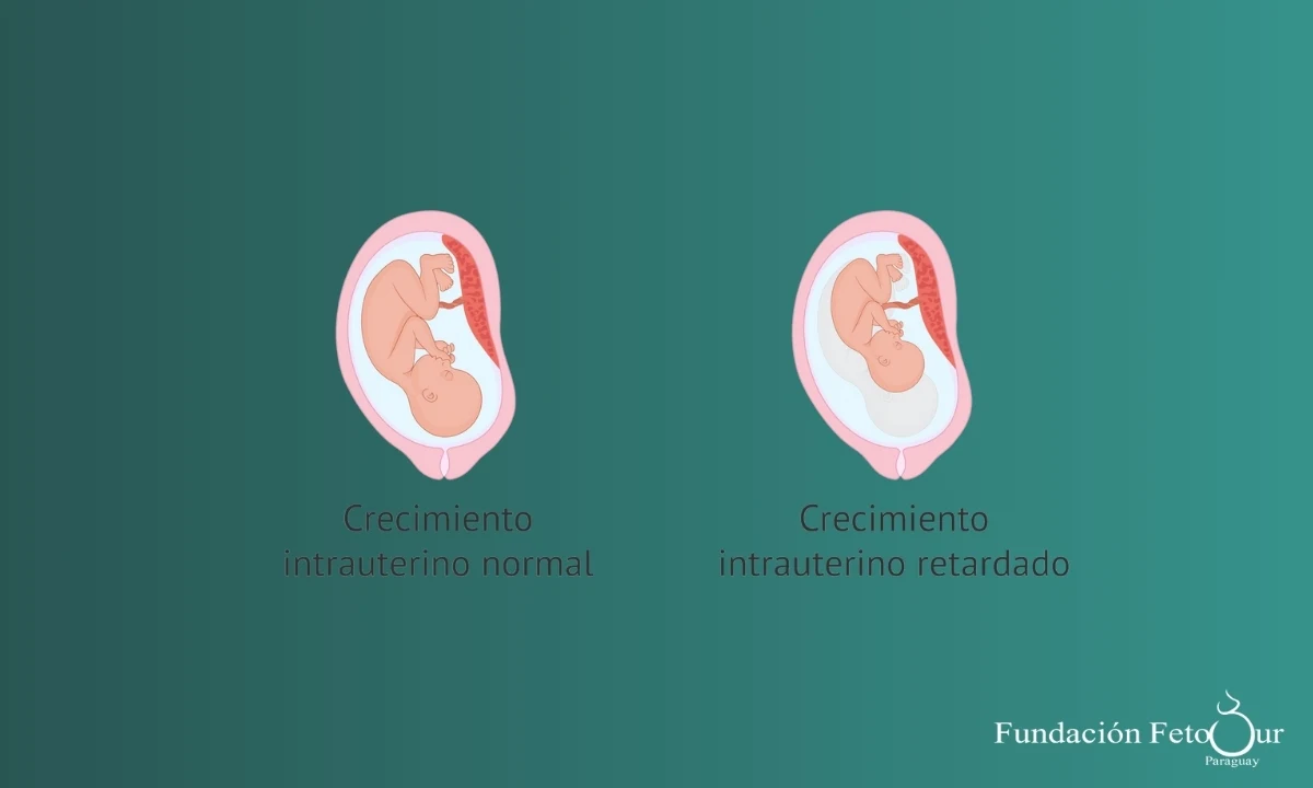 Retraso de Crecimiento Intrauterino Selectivo de un Gemelo