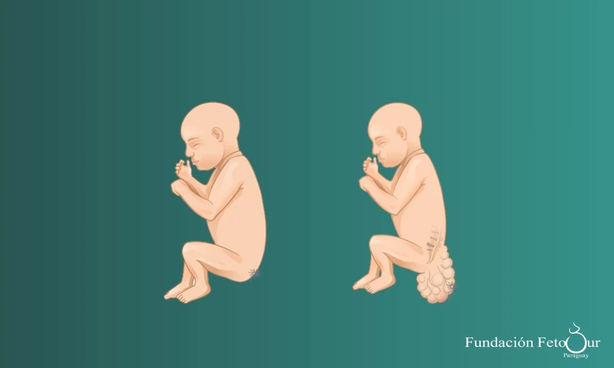 Teratoma Sacrococcígeo y otros Tumores Fetales